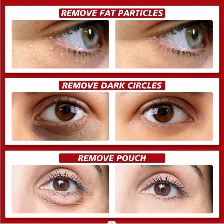 Fat Granules Removal Eye Serum Eye Milia Repair